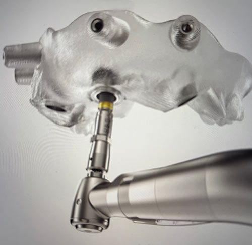 Guided Implant Surgery