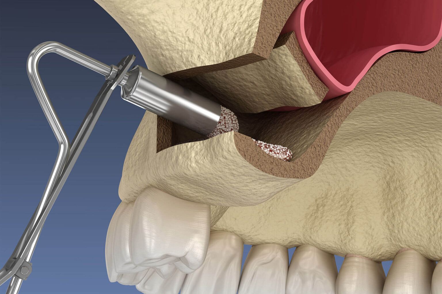 Sinus-Lift