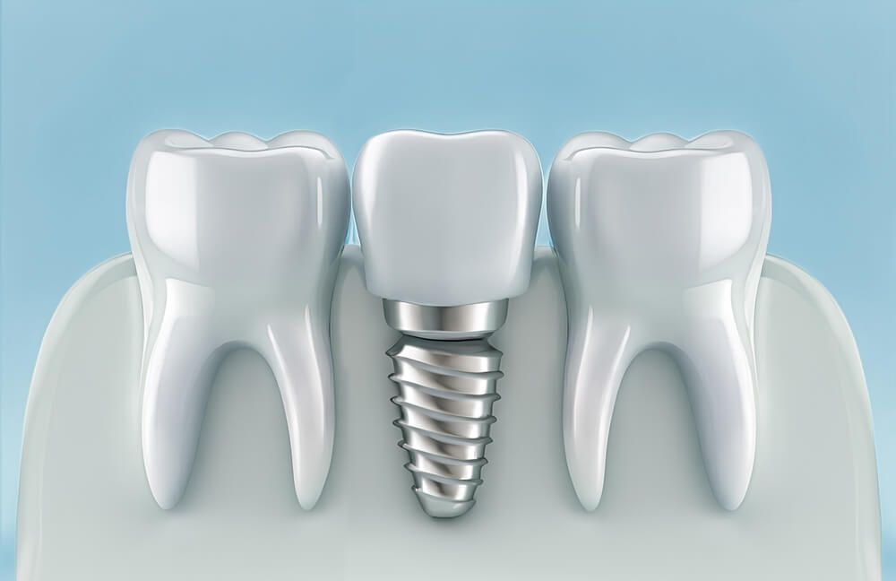 dental implant model
