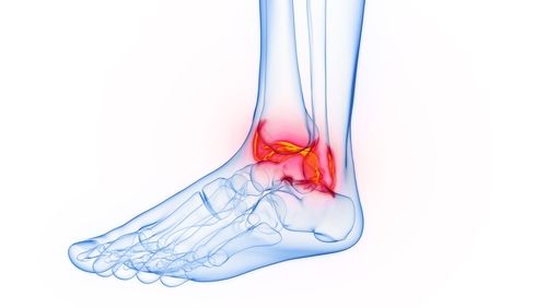3d,Rendered,Medical,Illustration,Of,Male,Anatomy,-,Inflamed,Ankle