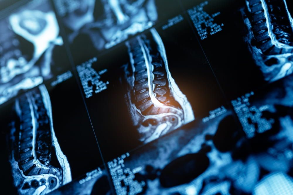 Pinched sciatic nerve in leg buttock, Detailed mri scan