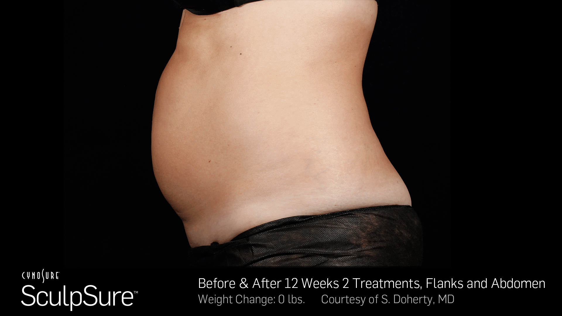 BA__Animated_SculpSure_S_Doherty_Core_2Tx_12weeks_02.1