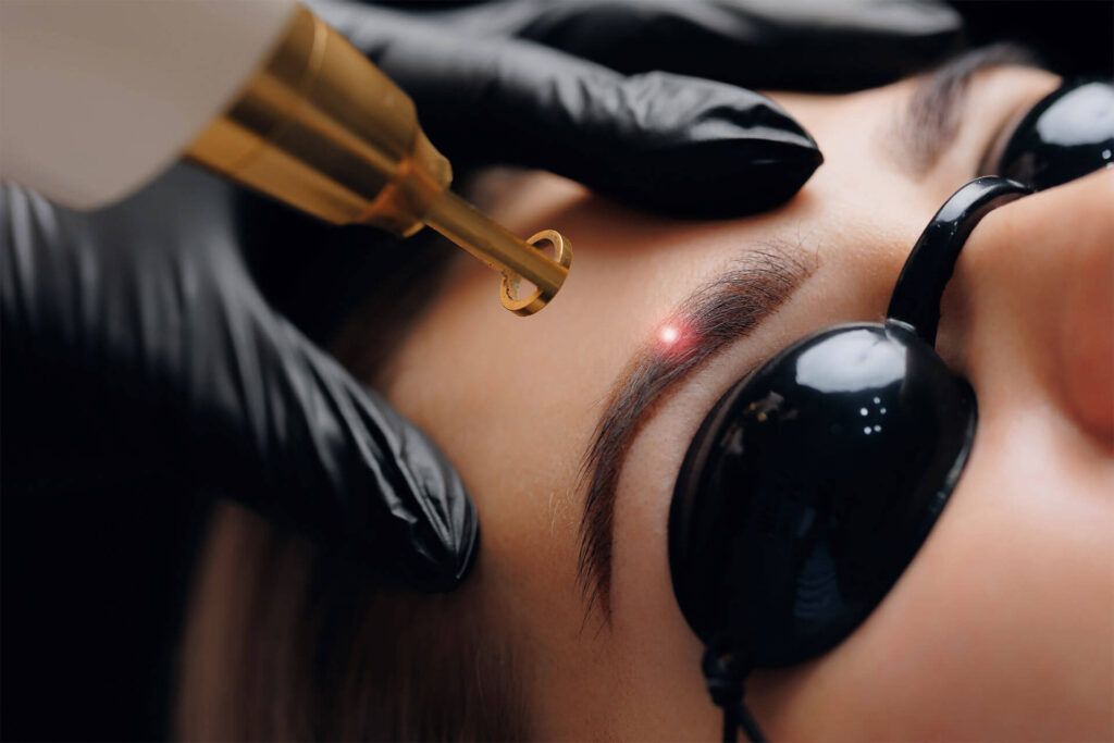 Laser Tattoo Removal