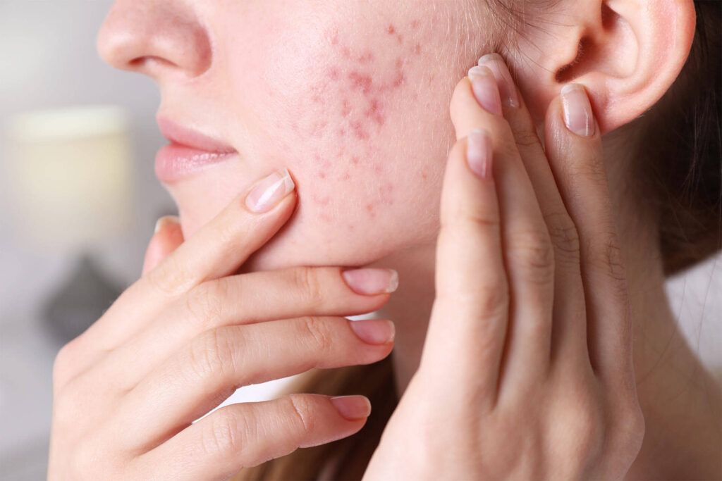 Acne Scars