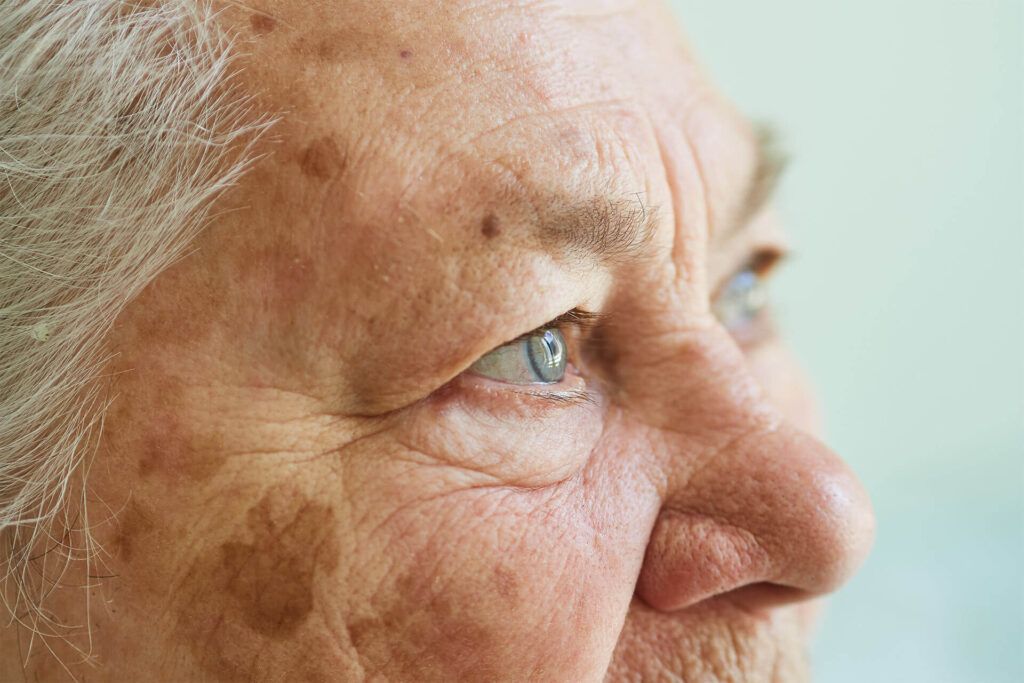 Age Spots
