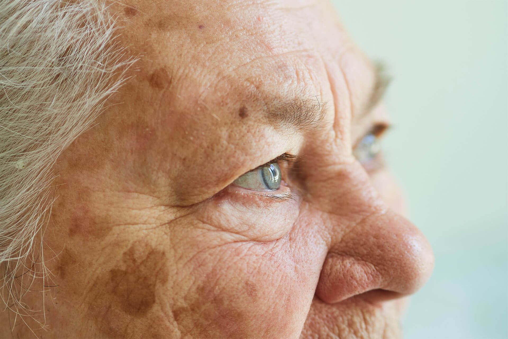 Age Spots