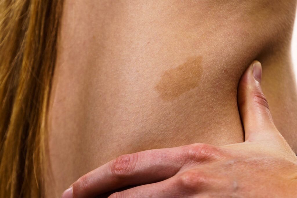 Birthmarks