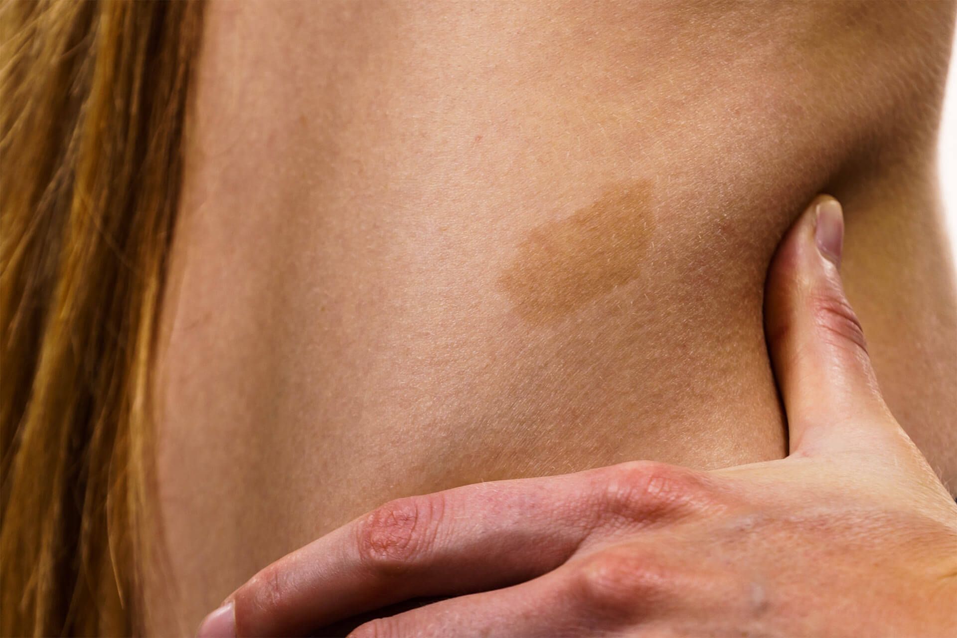 Birthmarks