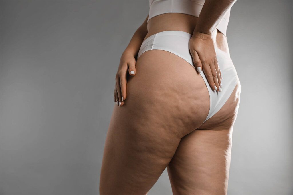 Cellulite Treatment