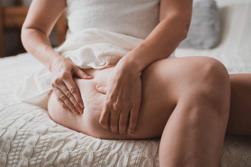 Close-up of female body with cellulite