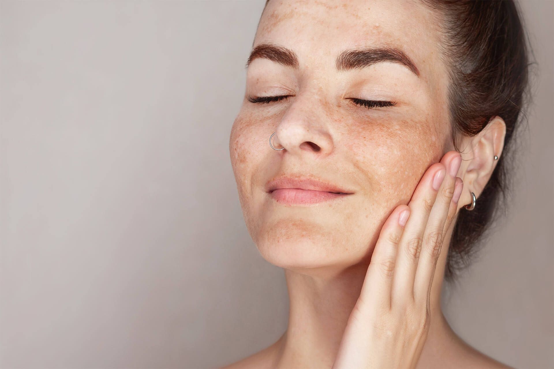 Melasma