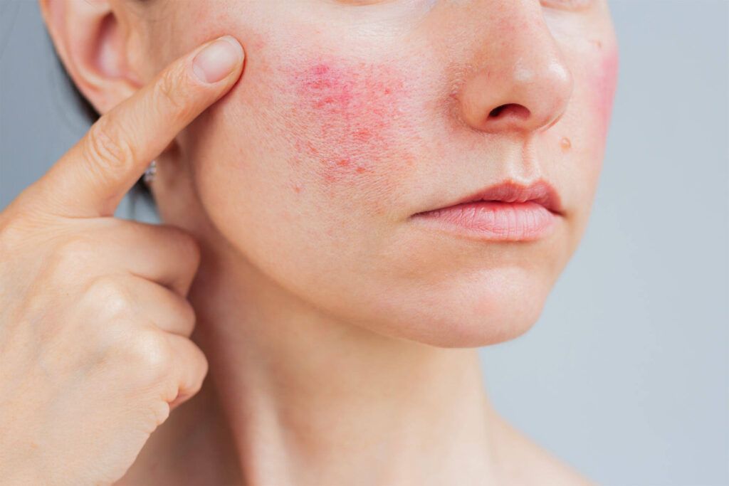 Rosacea Treatment