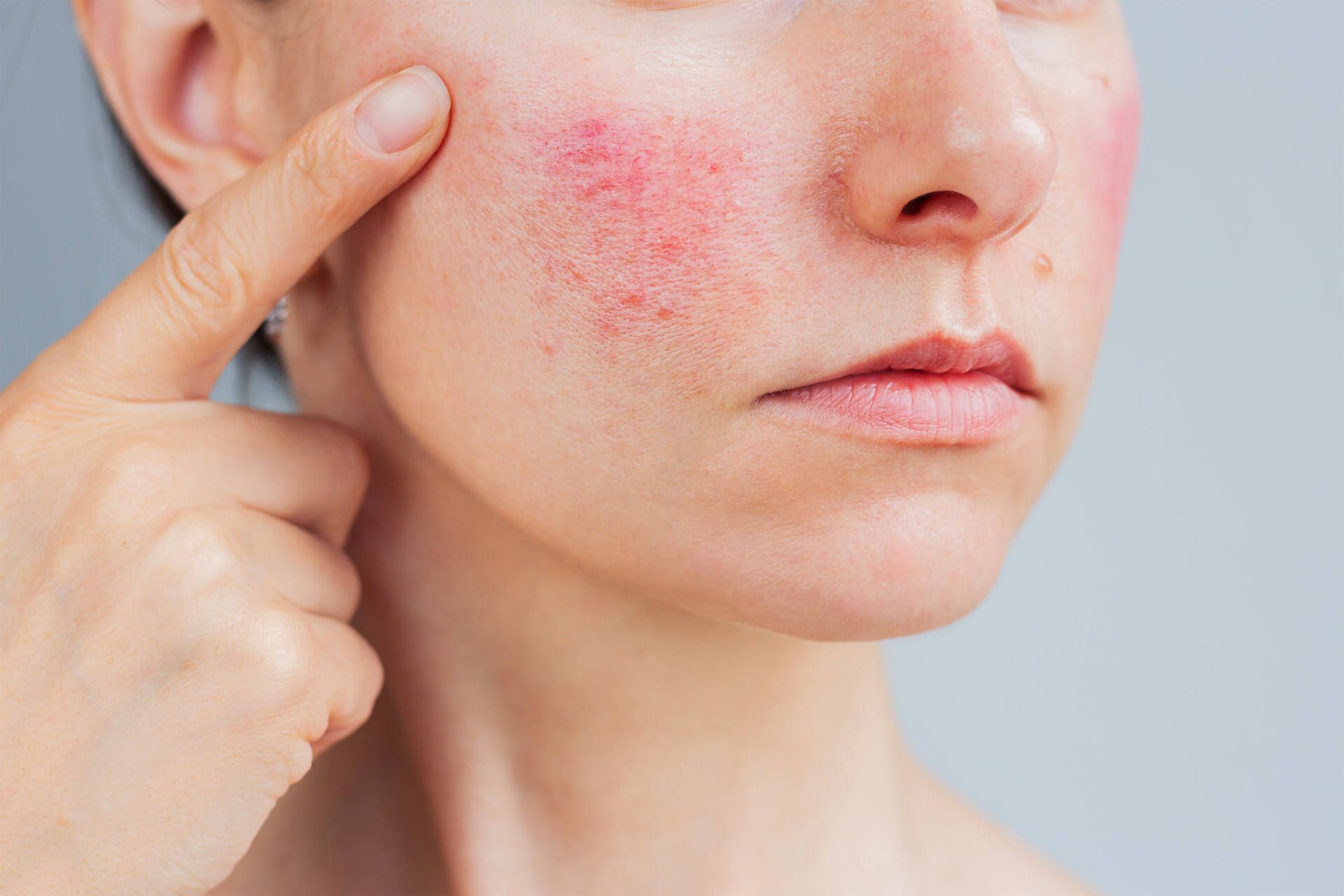 Rosacea Treatment
