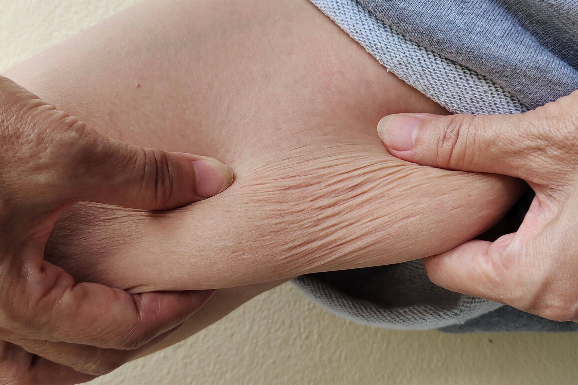 Sagging Skin