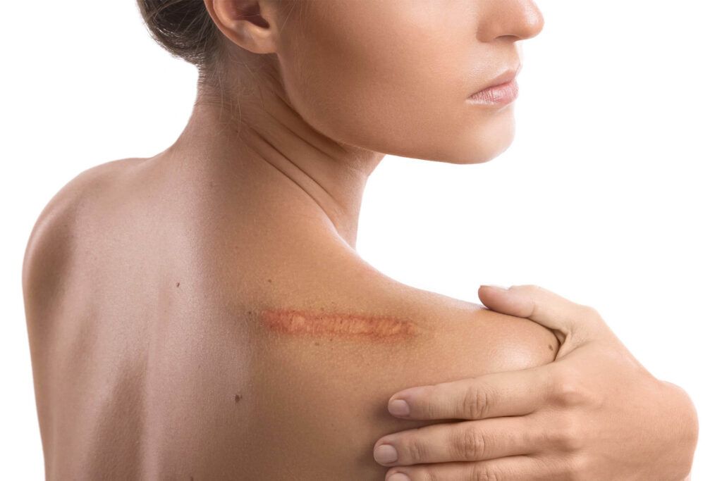 Scars
