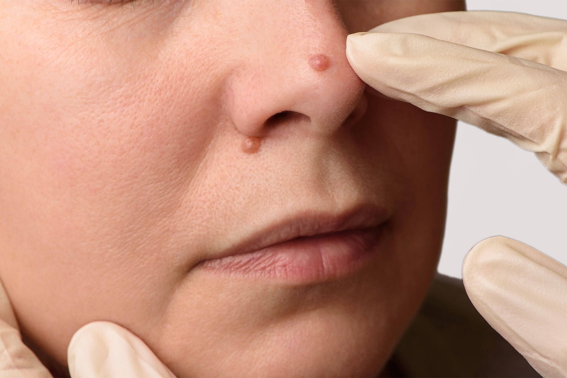 Skin Growth Removal
