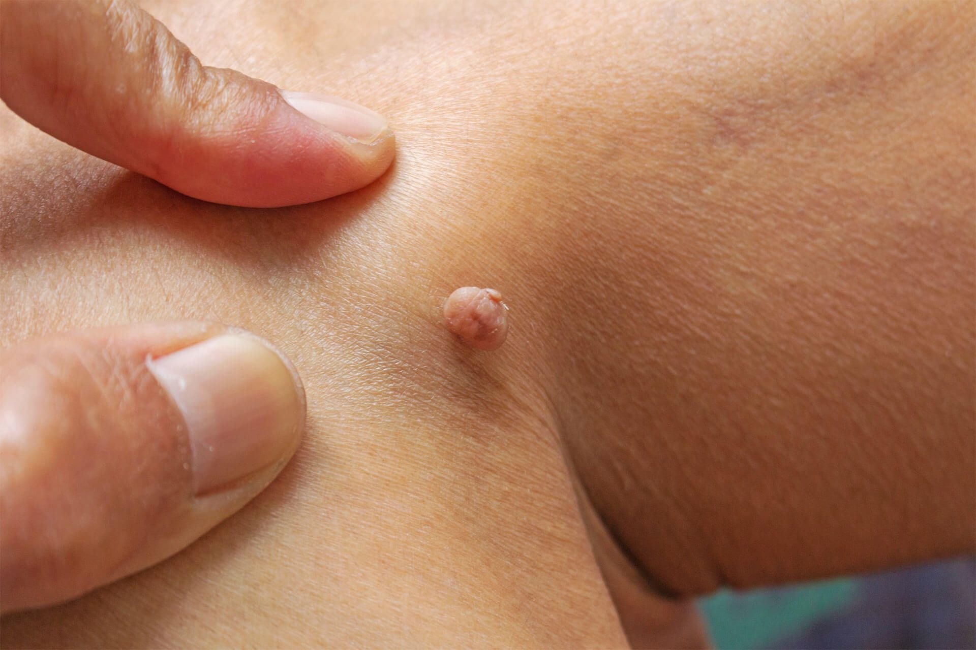 Skin Growths