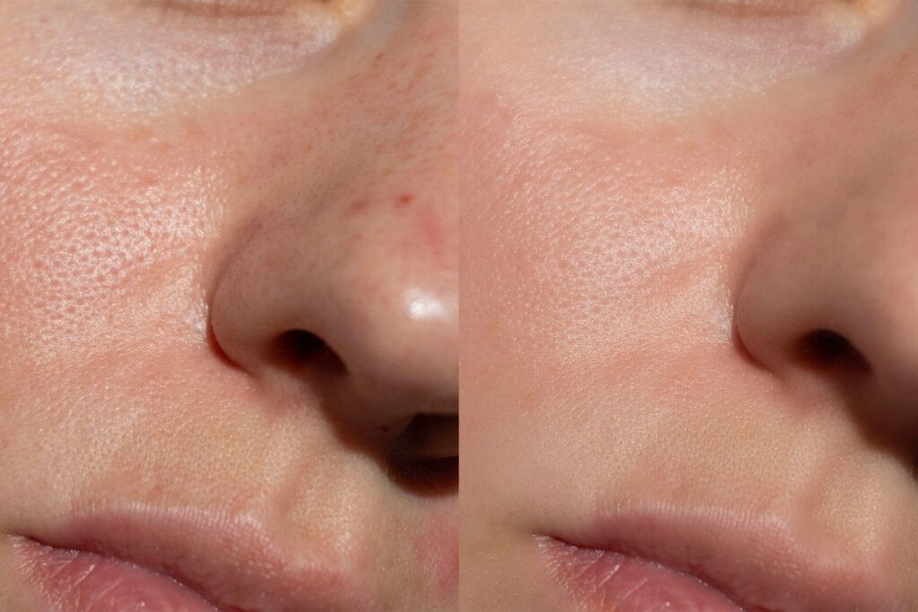 Side-by-side comparison of female skin texture showing pores and redness before and after treatment.