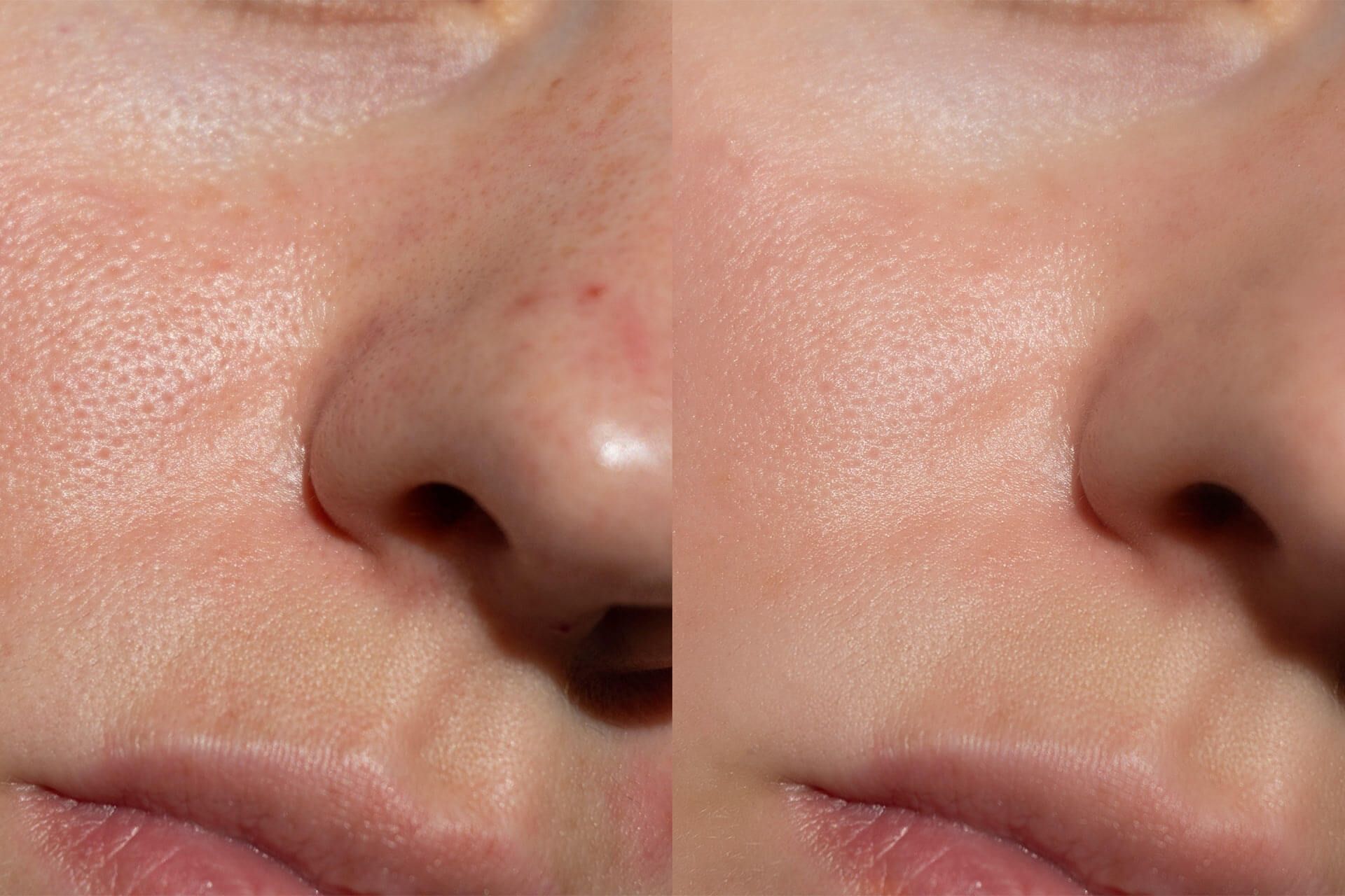 Side-by-side comparison of female skin texture showing pores and redness before and after treatment.