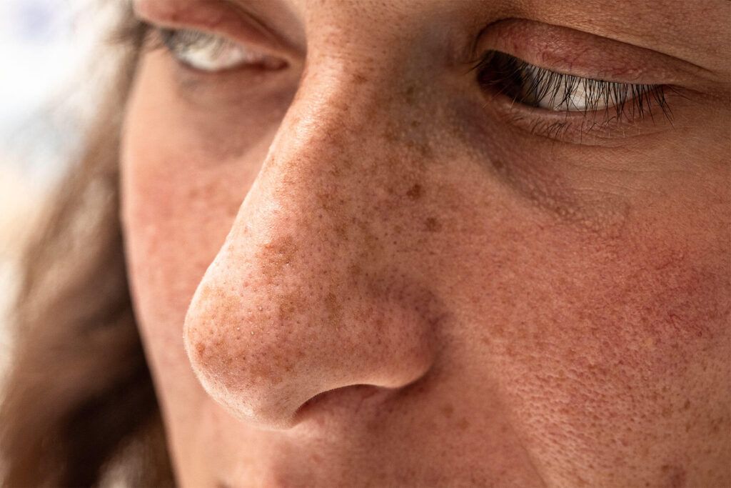 A closeup portrait of a thirty year old caucasian girl, macro details of freckles and sun spots around the nose and cheeks, damage from harmful sun rays.