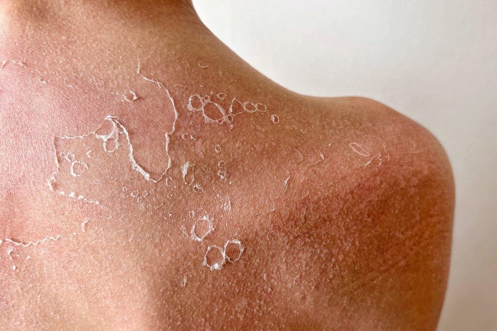 Sun Damage