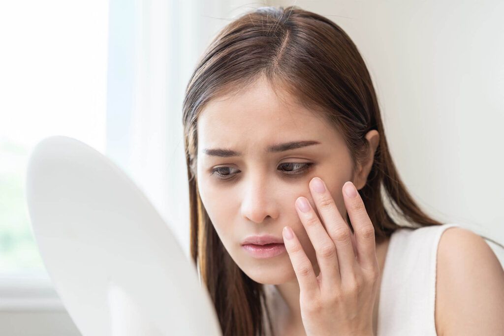 Under-eye Circles
