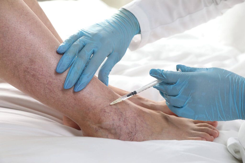 Vein Treatment