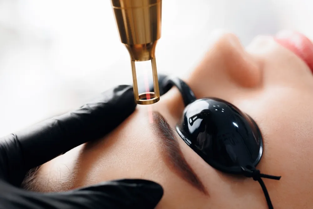 Laser removal of tattoo permanent makeup eyebrow of young woman in salon.