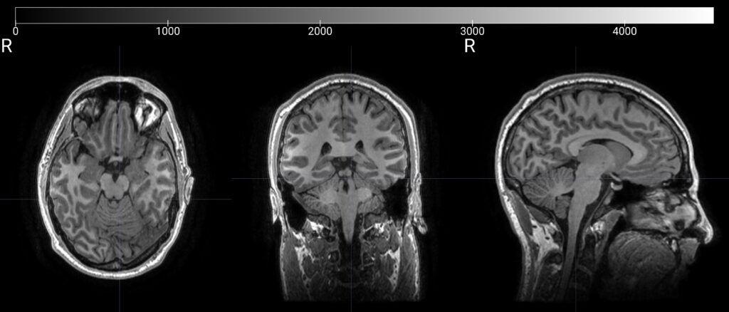 HALO™ analysis platform, which evaluates brain network patterns