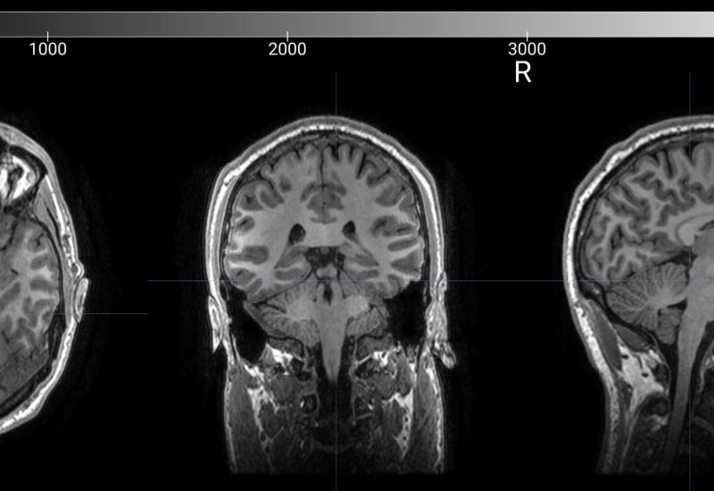 HALO™ analysis platform, which evaluates brain network patterns