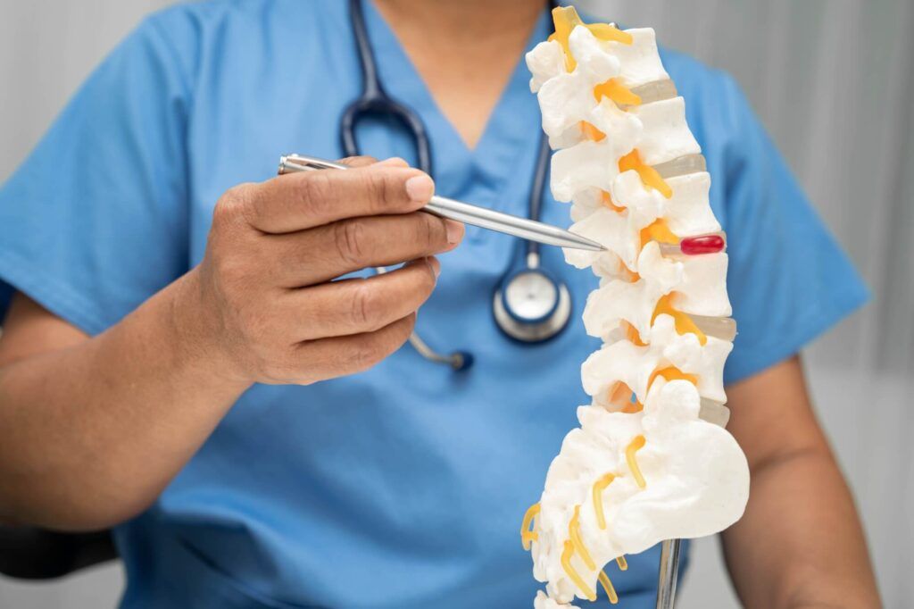 Asian doctor holding spinal nerve and bone model, Lumbar spine displaced herniated disc fragment