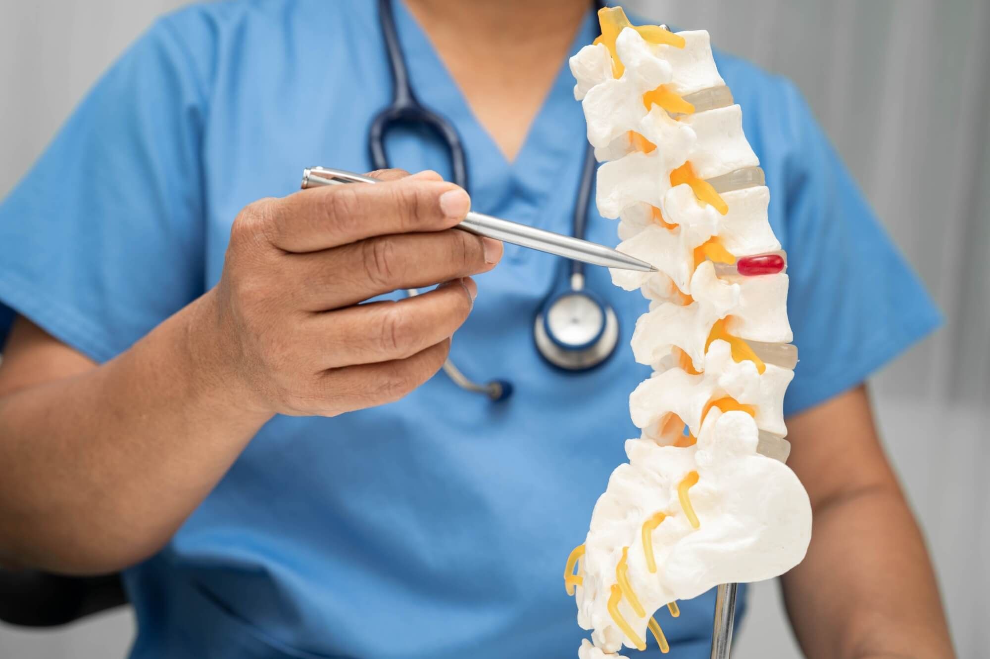 Asian doctor holding spinal nerve and bone model, Lumbar spine displaced herniated disc fragment