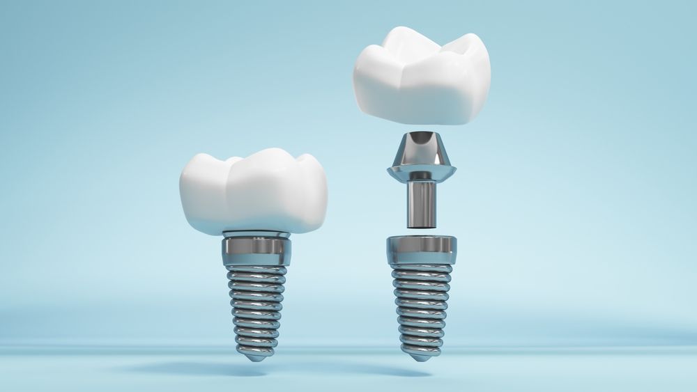 Dental Implants (Single & Multiple Tooth Replacement)