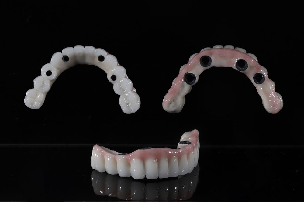 Full-Arch Dental Implants (All-on-X / Teeth-in-a-Day)