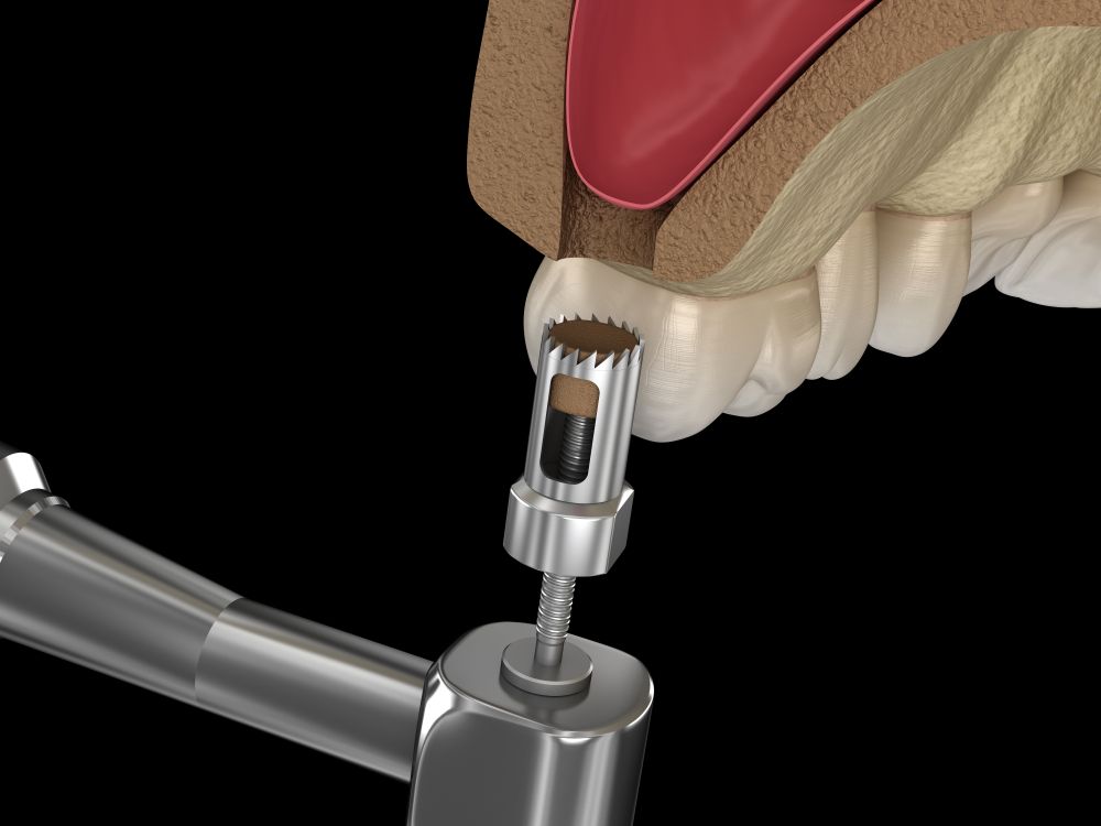 Immediate Implants & Same-Day Tooth Replacement