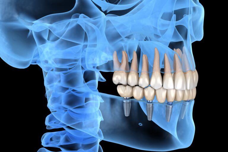 Mandibular prosthesis All on 6 system supported by implants. Medically accurate 3D illustration of human teeth and dentures concept