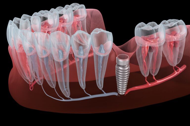 Result of unsuccessful dental implantation - nerve break. Medically accurate dental 3D illustration