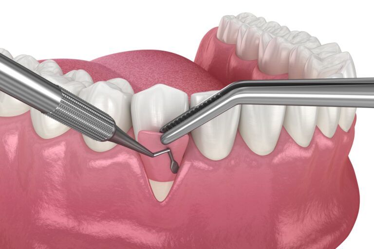 Gum Recession: Soft tissue graft surgery. 3D illustration of Dental treatment