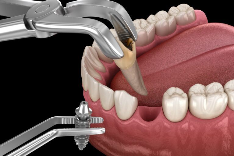 Extraction and Implantation, complex immediate surgery. Medically accurate 3D illustration of dental treatment