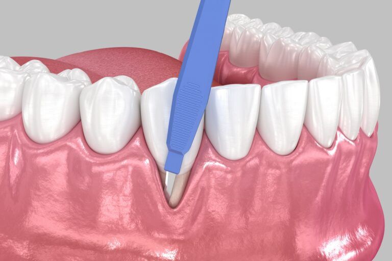 Gingiva Recession: Soft tissue graft surgery. 3D illustration of Dental treatment