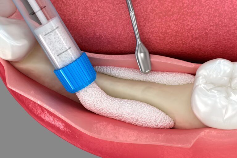 Bone grafting augmentation for tooth implantation. Medically accurate 3D illustration.