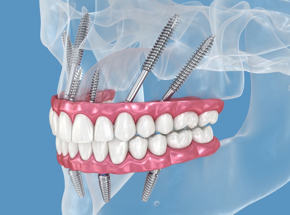 Zygomatic Implants