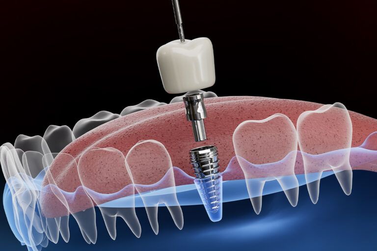 image illustrates the components of a dental implant