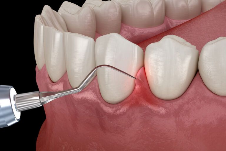 gum graft surgery, which is performed by a periodontist or dentist to address gum recession.