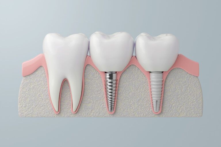 Zeramex Implants