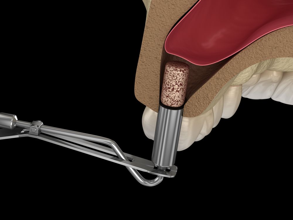 Bone Grafting & Sinus Elevation