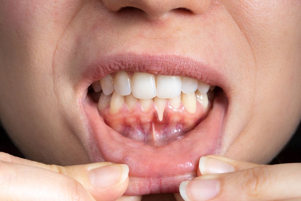 Gum Disease Treatment (Periodontal Therapy)