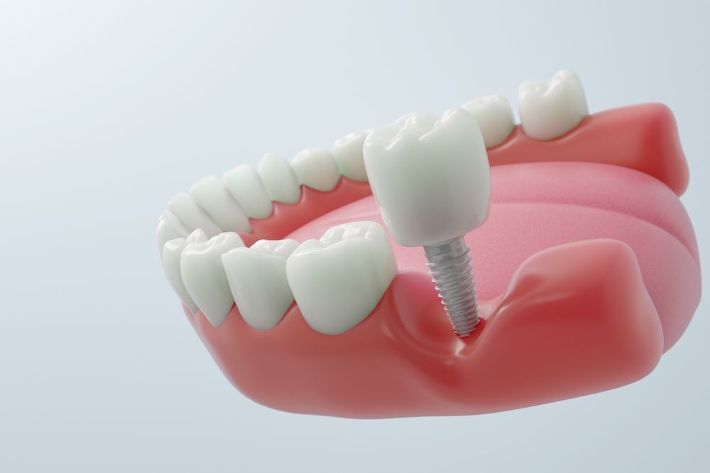 Zeramex Implants