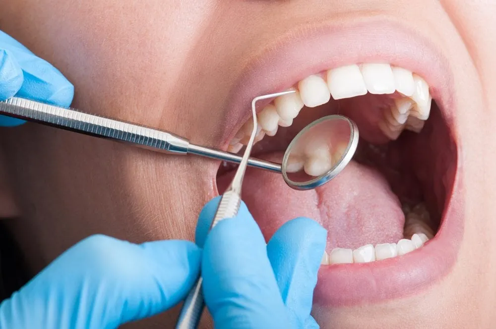 Periodontal Scaling & Root Planing