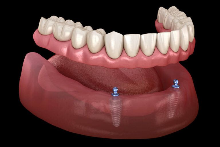 Mandibular removable prosthesis All on 2 system supported by implants with ball attachments.